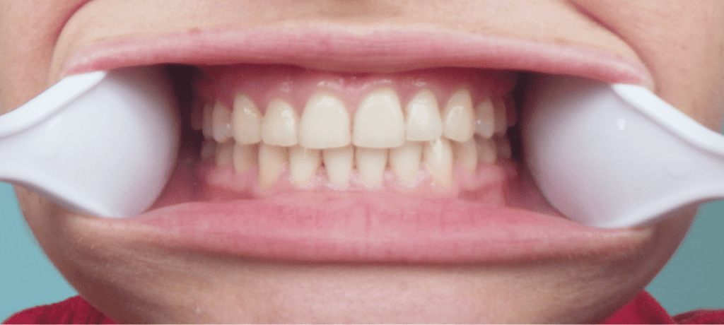 Front Teeth
