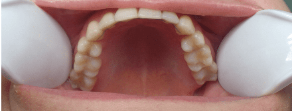 Layer 4 Top teeth