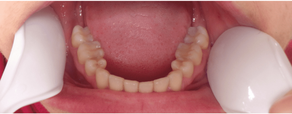 Layer 5 Bottom teeth