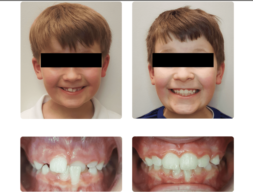 Phase I Crossbite (1)