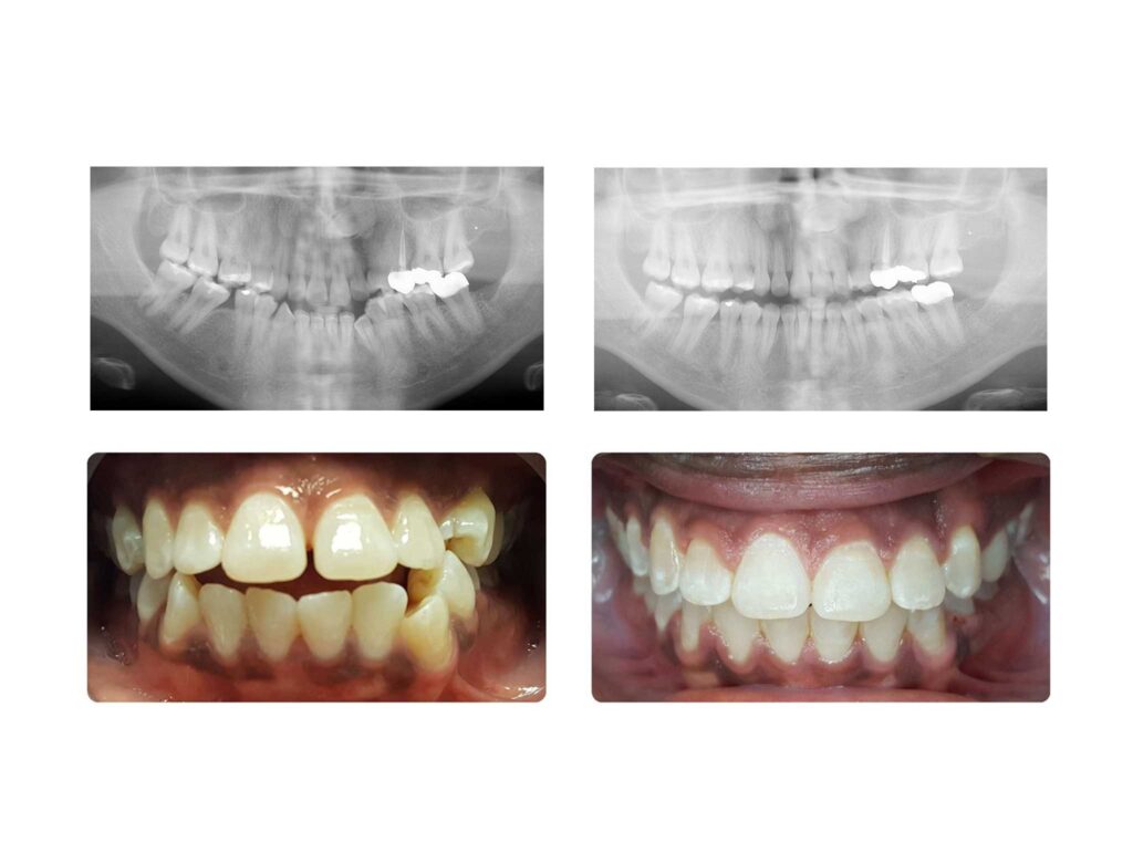 Impacted Tooth Adult Treatment